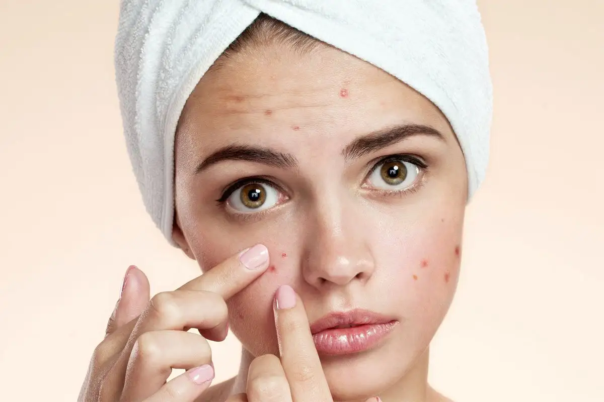 جایگزین‌های غذایی مناسب برای پوست مستعد جوش