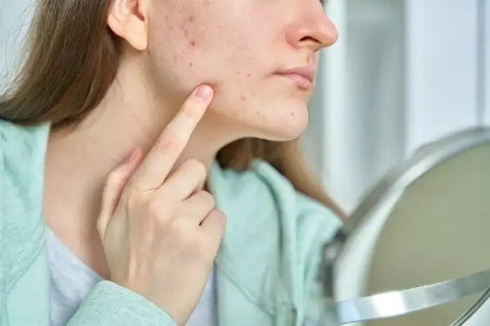 رئالیتی جوش بزرگسالی | چرا آکنه در بزرگسالی ادامه دارد؟